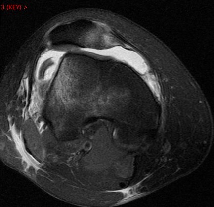 Figure 2 for case Patellar dislocation